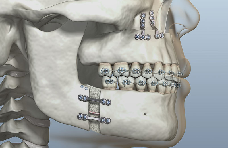 Cirurgia Ortognática