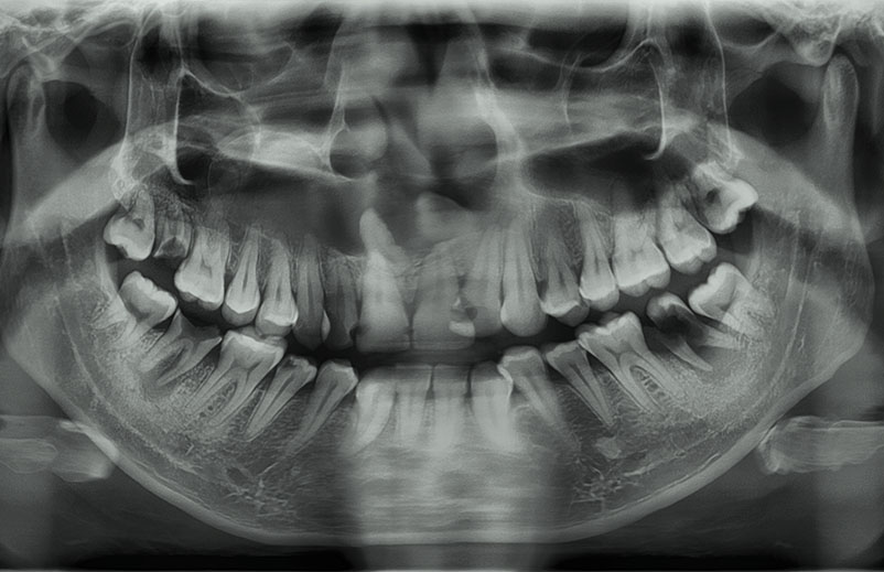 Cirurgia Buco-Maxilo-Facial